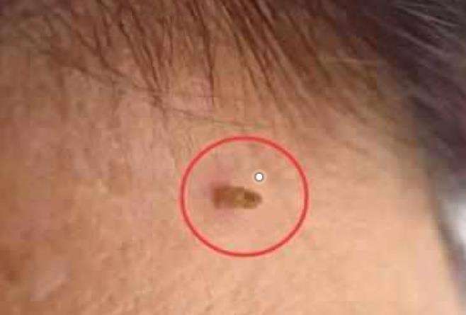 脖子上若经常出现"肉疙瘩,可能是"病变"的信号,早看早受益