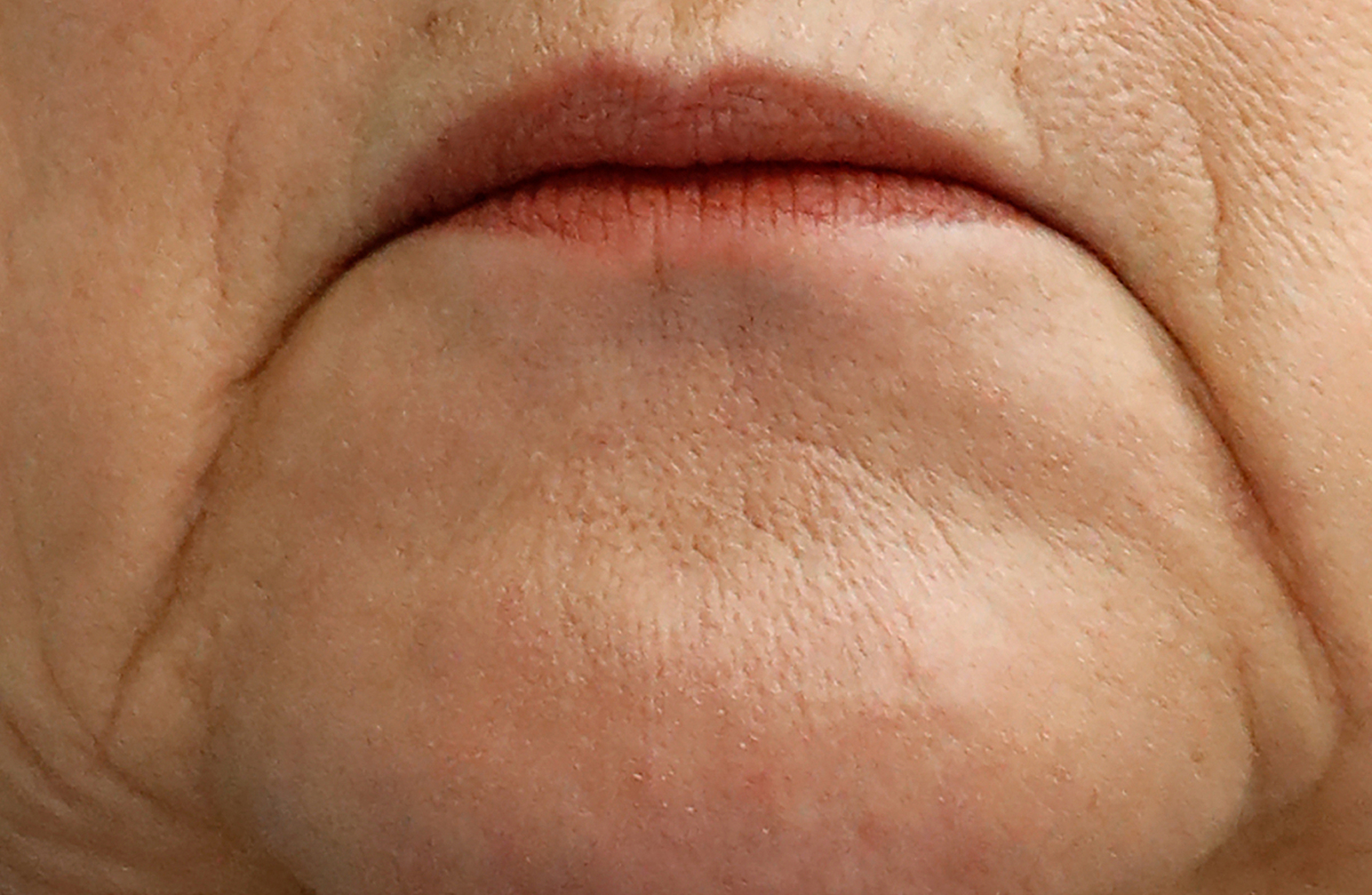 填充注射是目前减少口周纹的有效方法之一 可以通过注射透明质酸等