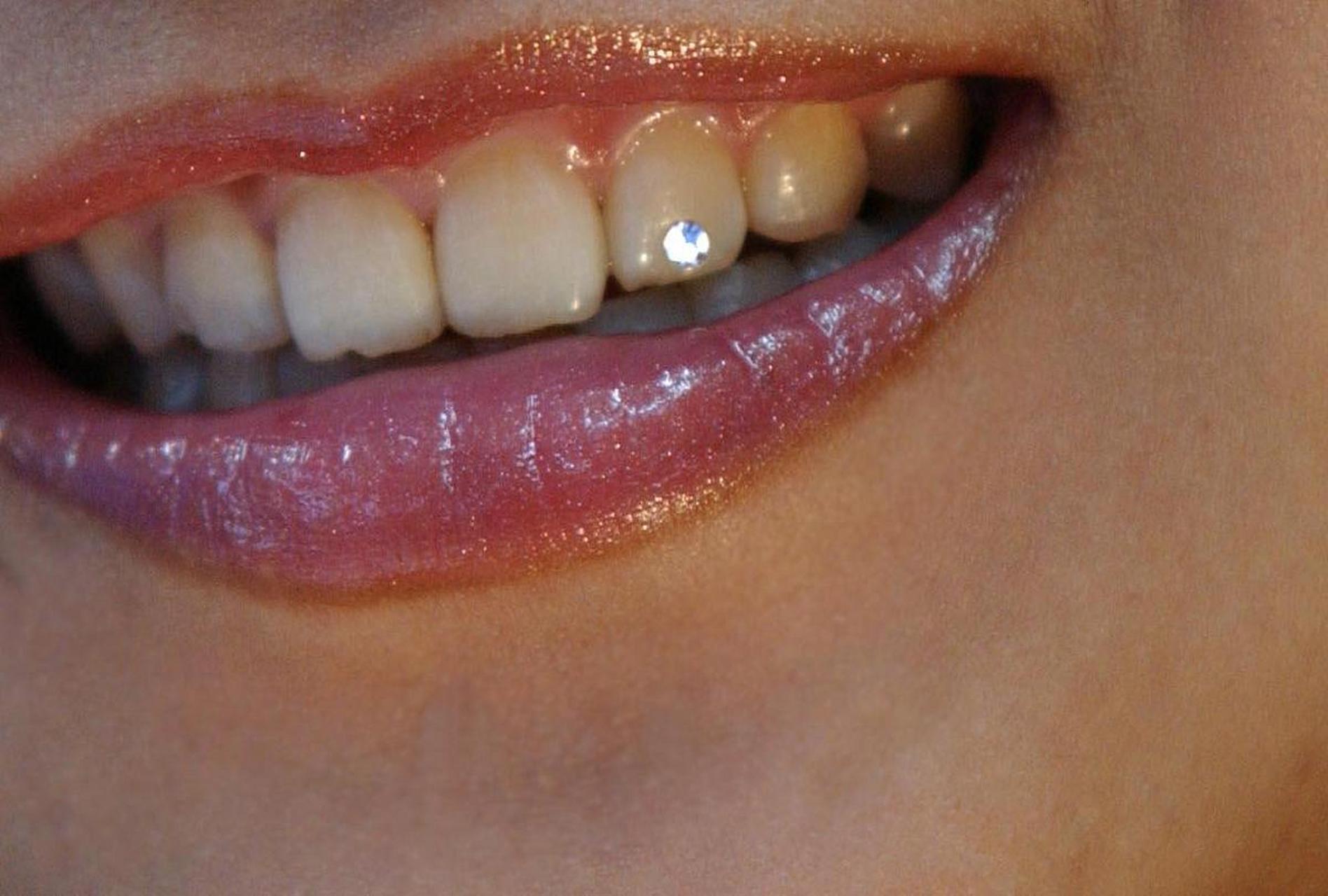 牙齿上有黄斑的原因不同,所以祛除的方法也是有差