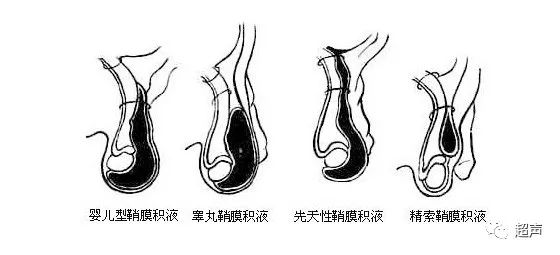 小儿鞘膜积液,你问我答!