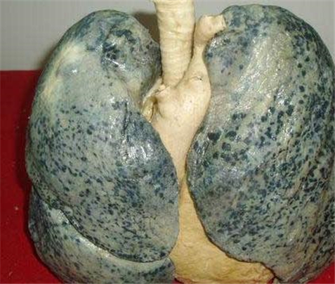吸烟五年的肺图片