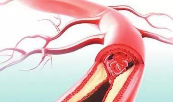 你一直忽视的健康"杀手"——管道脂肪