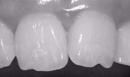 你有瓜子牙吗?千万不要再这样嗑瓜子了,否则牙医会给你套烤瓷牙