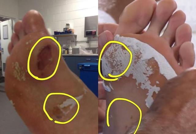 韩国人造假?郑泫晒右脚血肉模糊图 网友质疑:不该是左脚吗