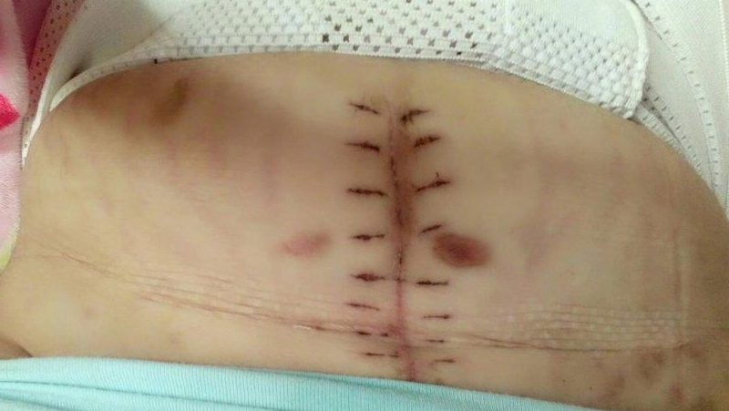 腹部微创手术疤痕图片图片