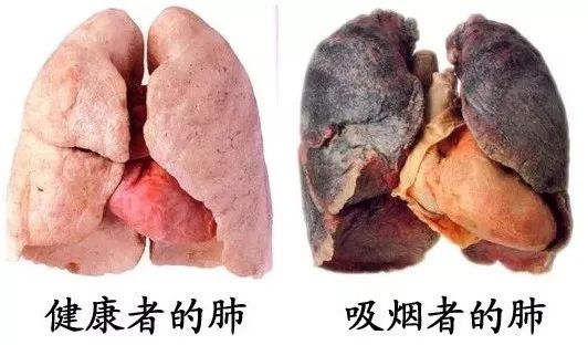 世界无烟日 | 吸烟对肺部的危害有多大呢?