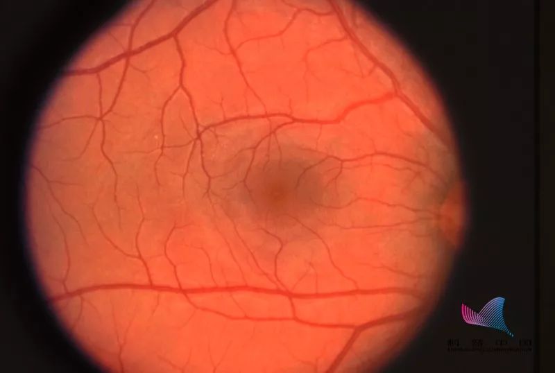 玩手机导致黄斑变性进而失明?手机有那么大危害吗