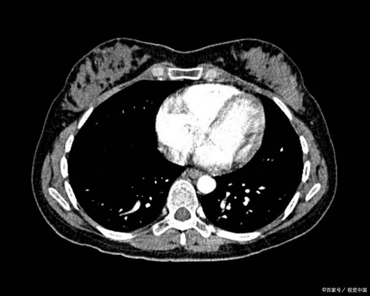 以为是普通感冒,却查出胸腔纵隔内有近10公分巨大肿瘤!