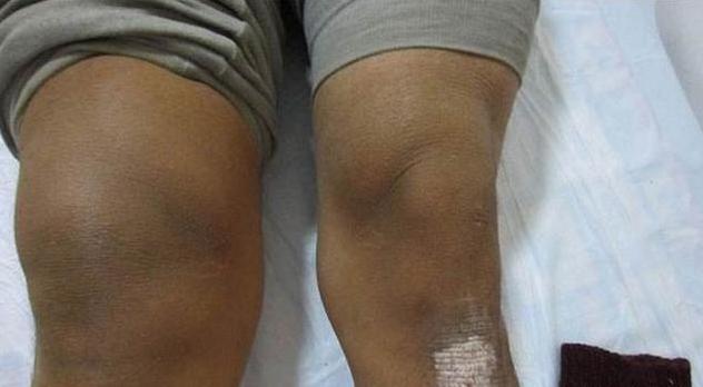 滑膜炎,关节积液痛到走不了路怎么办?