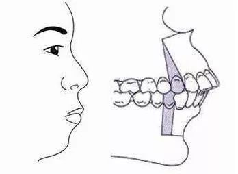 龅牙怎么矫正图片