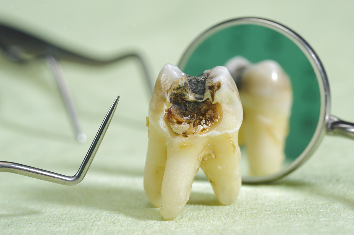 有个大牙洞,之前疼得要命,蛀牙非常严重怎么治?