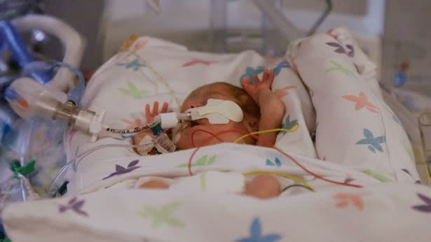 女子上厕所突然生下453克早产儿,孩子早产三个月竟奇迹生还