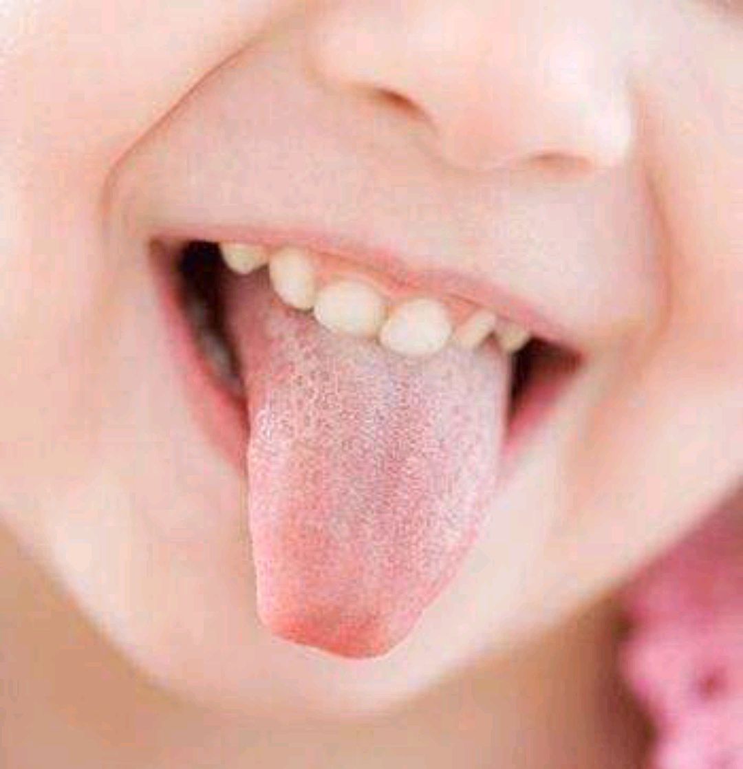 舌苔腻,孩子吃不胖的原因找到了:脾虚