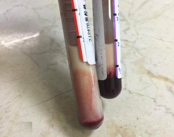 医生都惊呆了,抽出的血居然是乳白的
