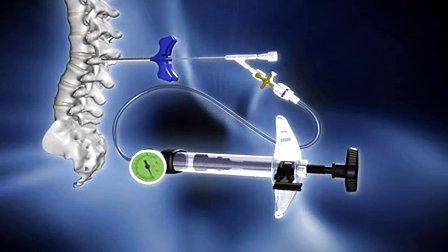 老年人脊柱骨折,到底能不能打一针椎体成形?