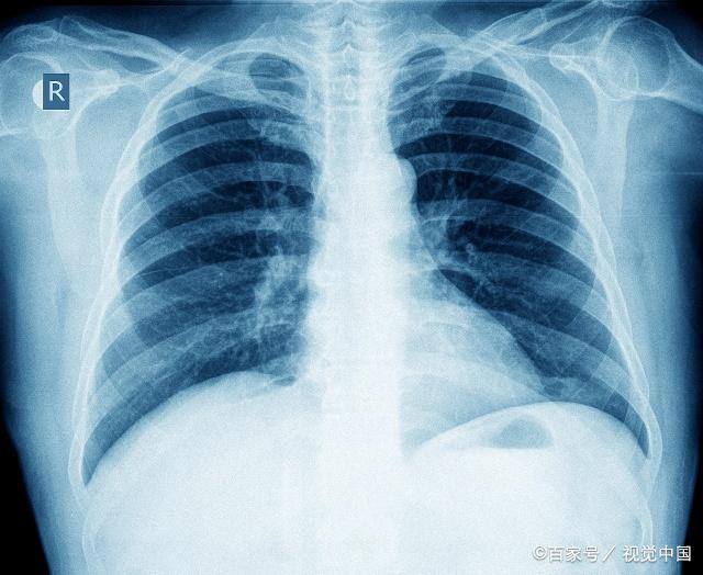 肺部感染片子图片图片