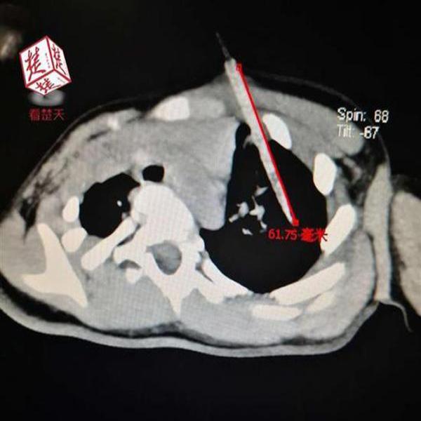 边吃鸡肉串边奔跑不小心摔倒在地,2岁女童肺部被竹签扎穿
