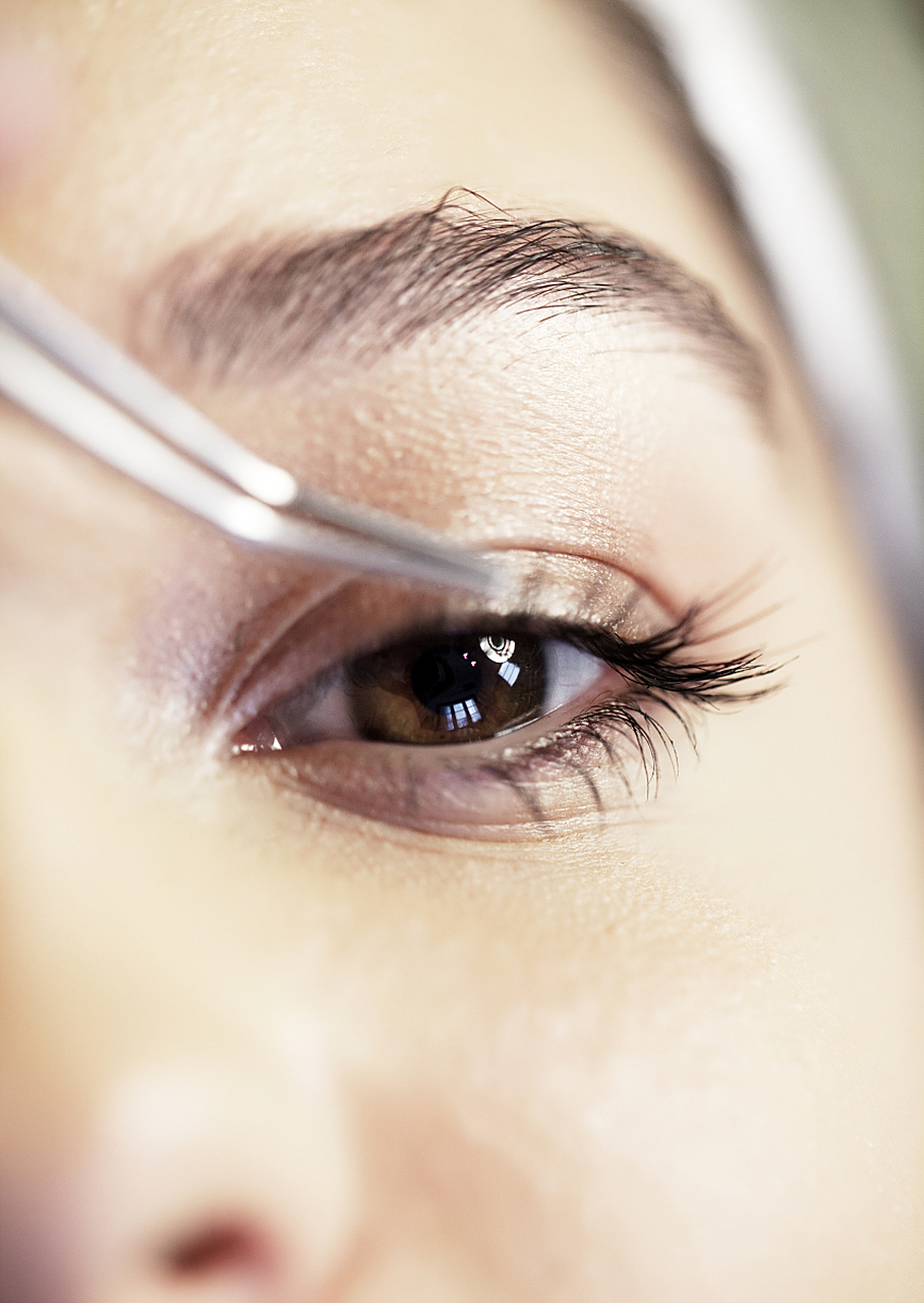 双眼皮埋线手术是一种常见的美容手术,通过在眼睑皮下埋入一根线,使