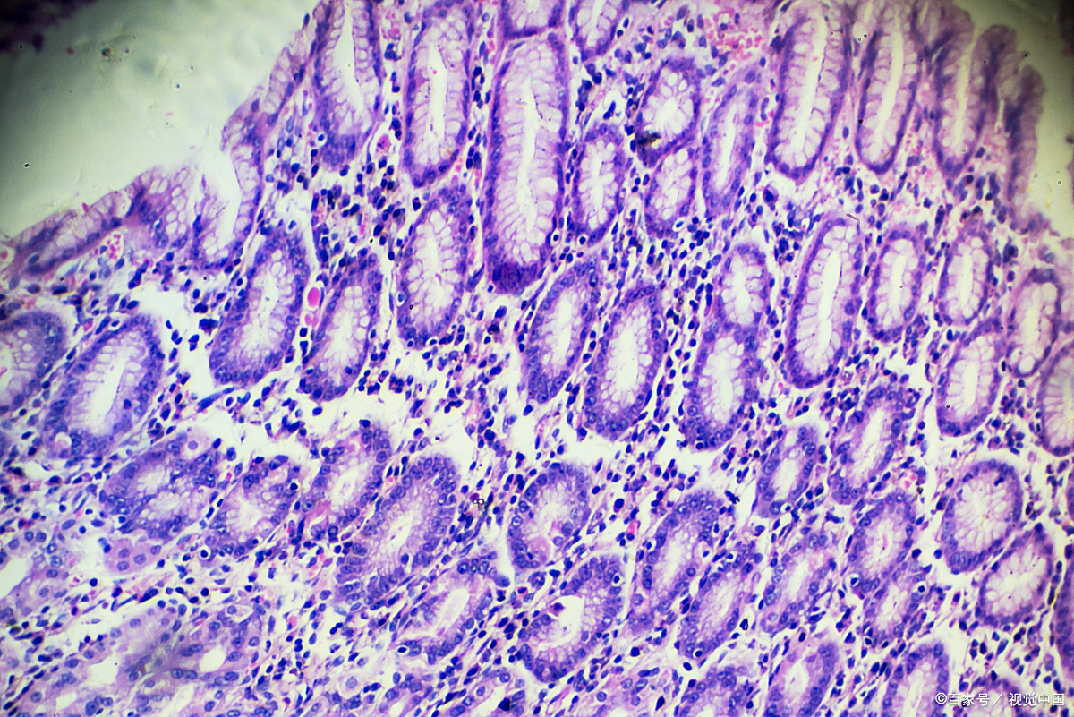 首先,肠上皮化生是一种病理变化,简单来说就是胃黏膜上皮细胞被类似