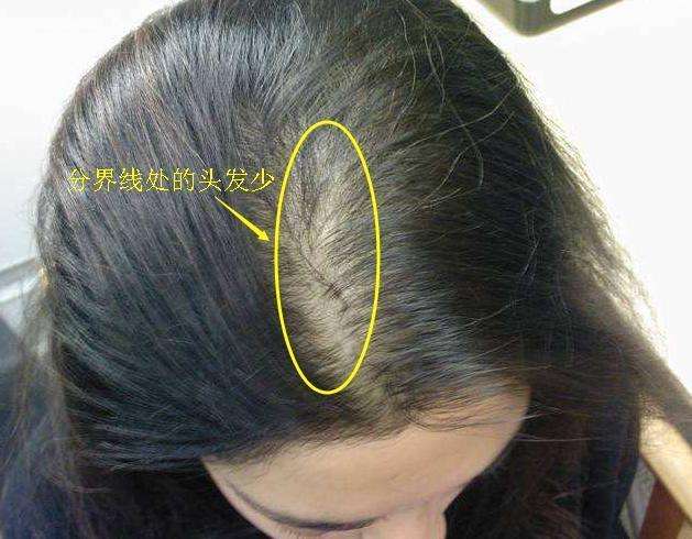 脸上螨虫扎堆怎么办?巧用农村一种药草,螨虫不敢再来