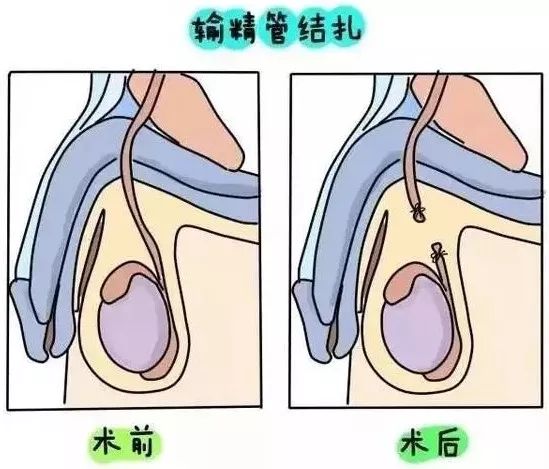 男性绝育手术的科普