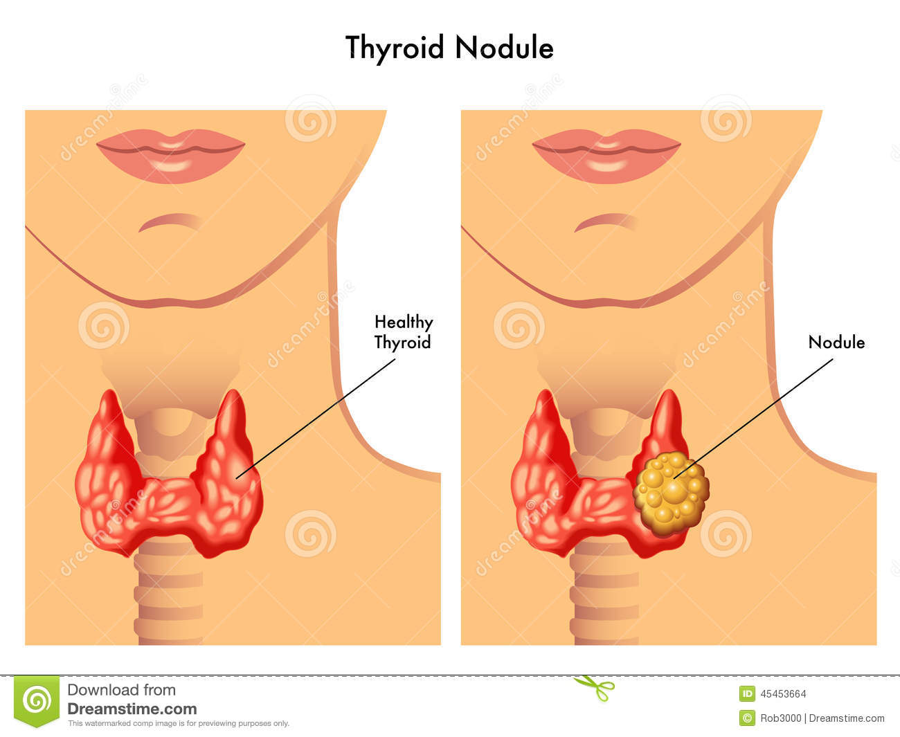 女性甲状腺位置图图片