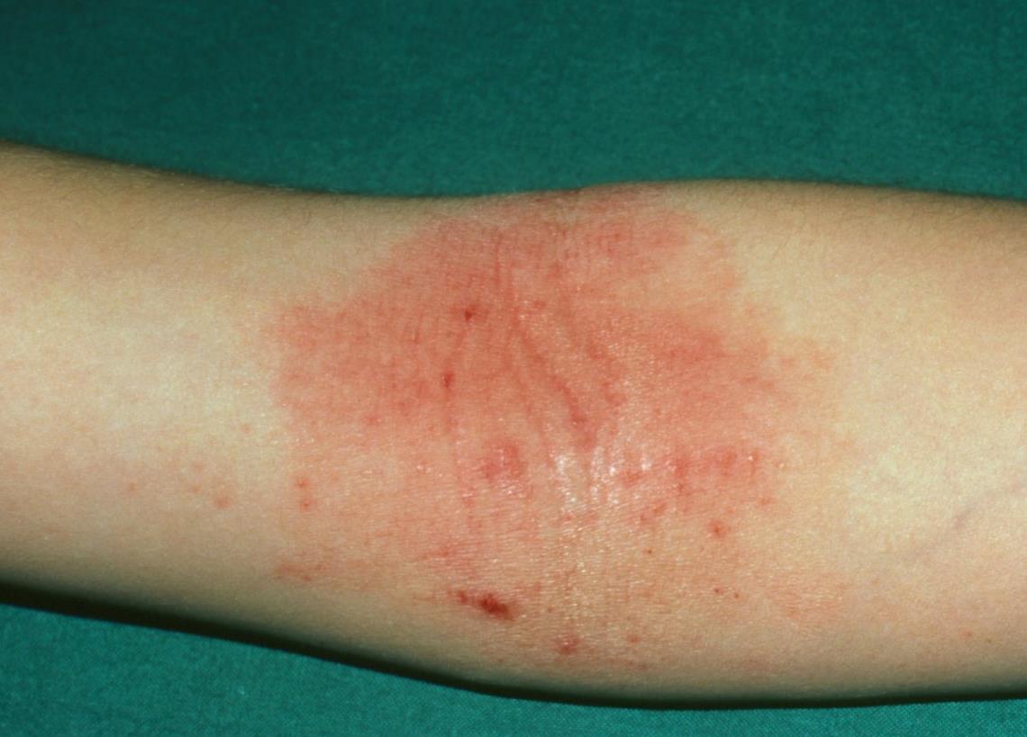 睡觉皮肤瘙痒 由于糖尿病患者血糖升高,体内糖分无法及时代谢,就会