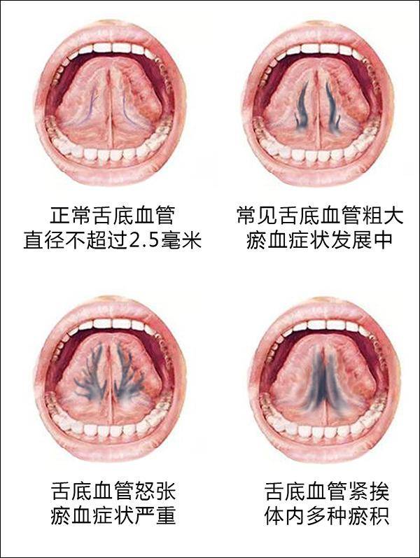 正常舌底静脉图片