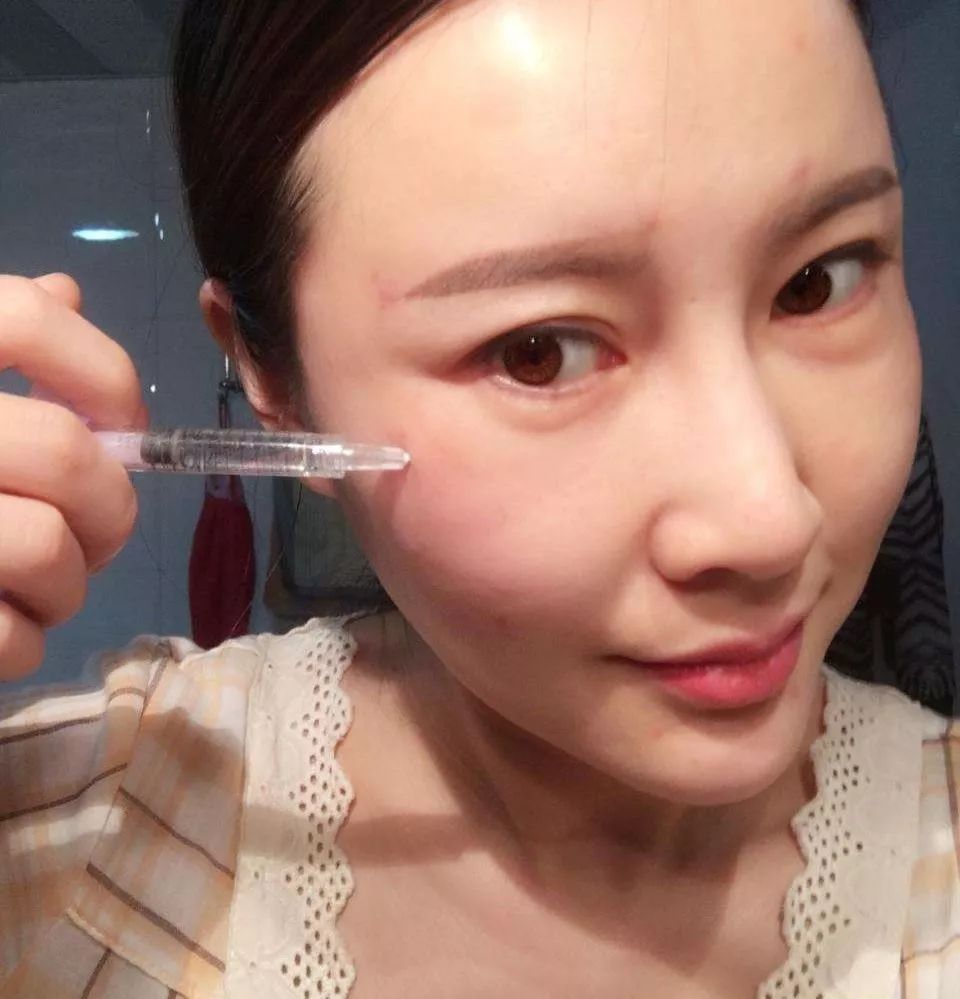 玻尿酸打多了会有副作用吗?