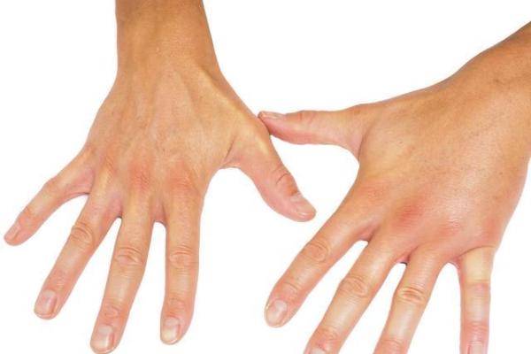手容易出现肿胀是什么原因?可能是肾炎"找上门"来了