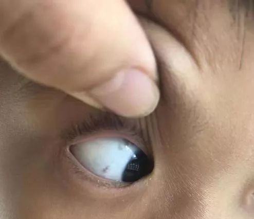 孩子眼睛有黑点是怎么回事?