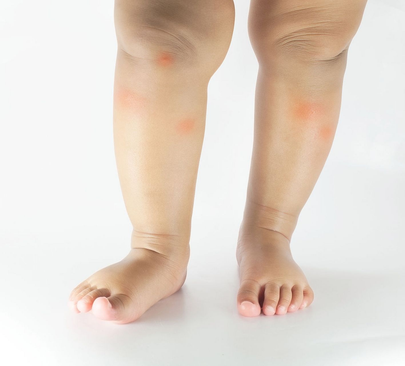 下肢水肿,小心肾病找上门 出现肾病,特别容易会出现水肿的问题.