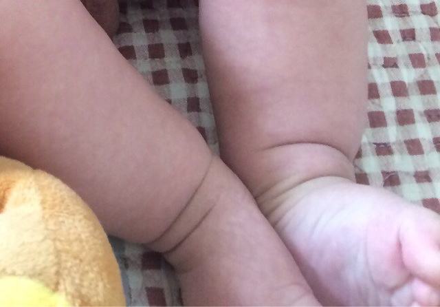 婴儿臀纹不对称的图片图片