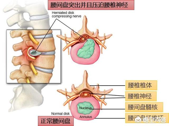 腰间盘突出会压迫到神经吗?有什么依据?看完涨知识了