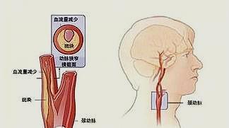 脑栓塞示意图图片