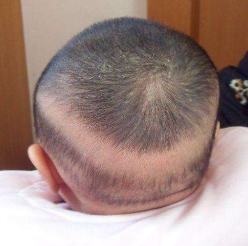 6个月宝宝爱挠头,宝妈以为是天气热,送医检查后,医生怒斥无知