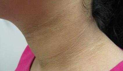 10胖女孩,脖子黑黑的,被同学嘲笑,母亲带到医院检查后乐了!