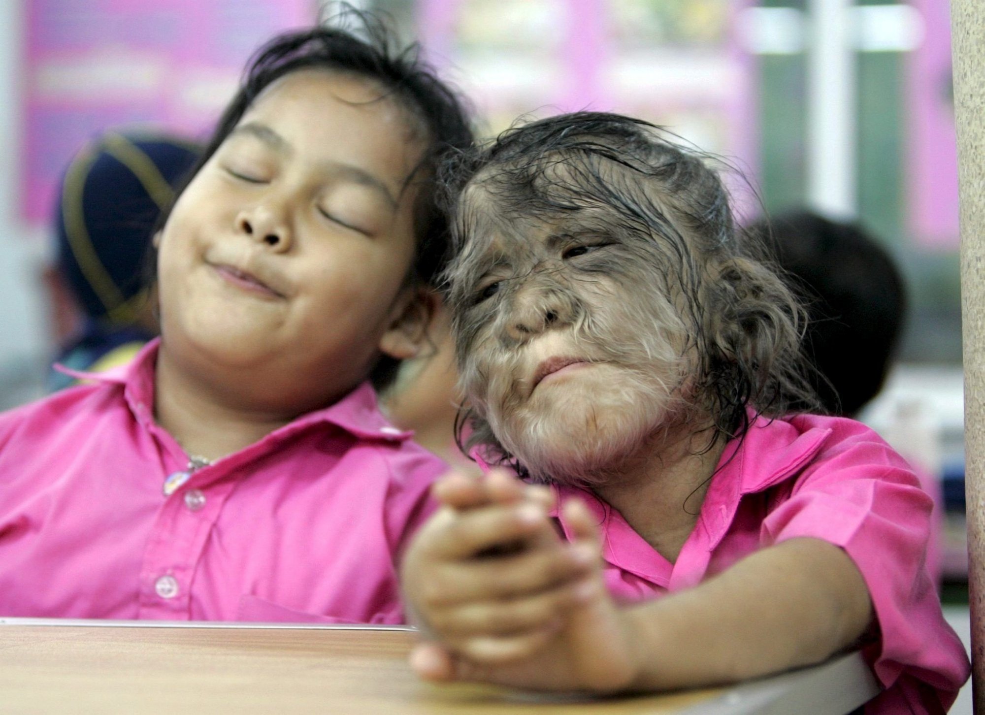 西班牙16名孩子变成"狼人" 调查后才发现问题源头来自于印度