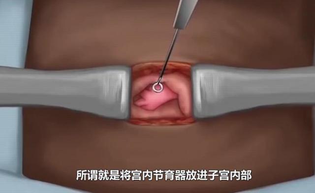 女性绝育手术"上环"是怎么做的?组图播放全程,忍不住心疼女人