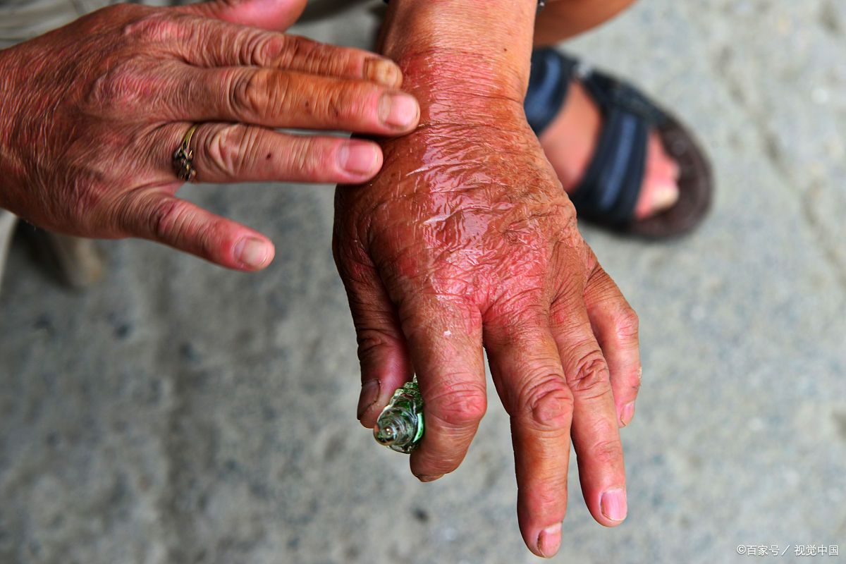 100张麻风病人图片被毒蜂蛰的图片麻风病现在还存在吗早期麻风病图片