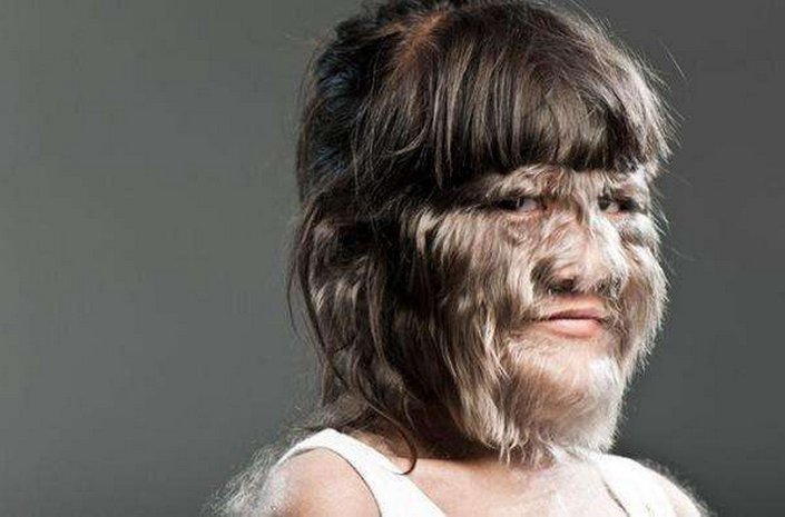 当她得上这种疾病时,她的脸上会长满浓密的毛发.