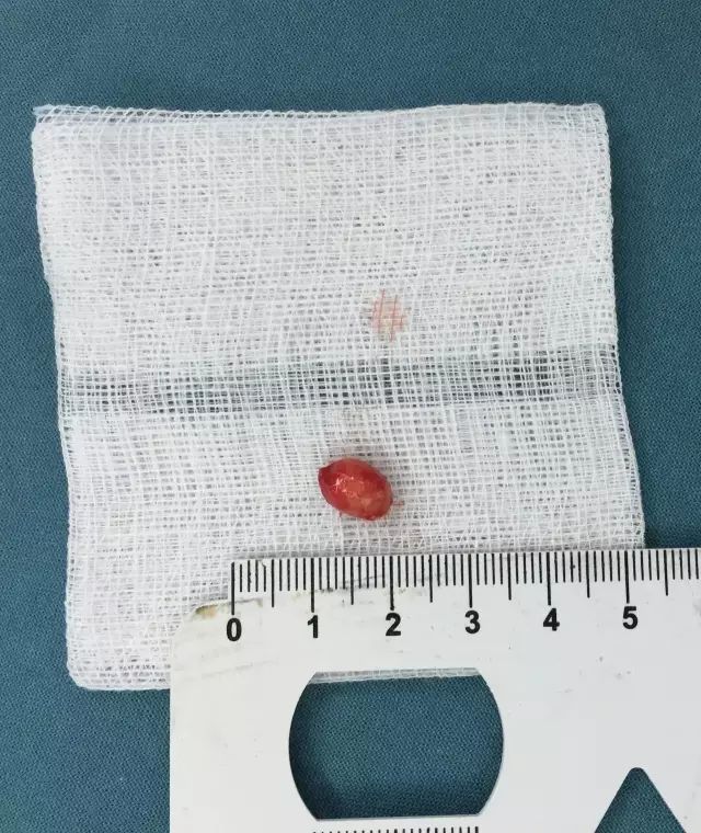 表皮样囊肿~儿童最常见的眼眶肿物