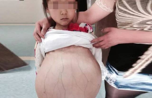 5岁女孩大肚子,去医院医生说立即手术,原因是父母做了这件事