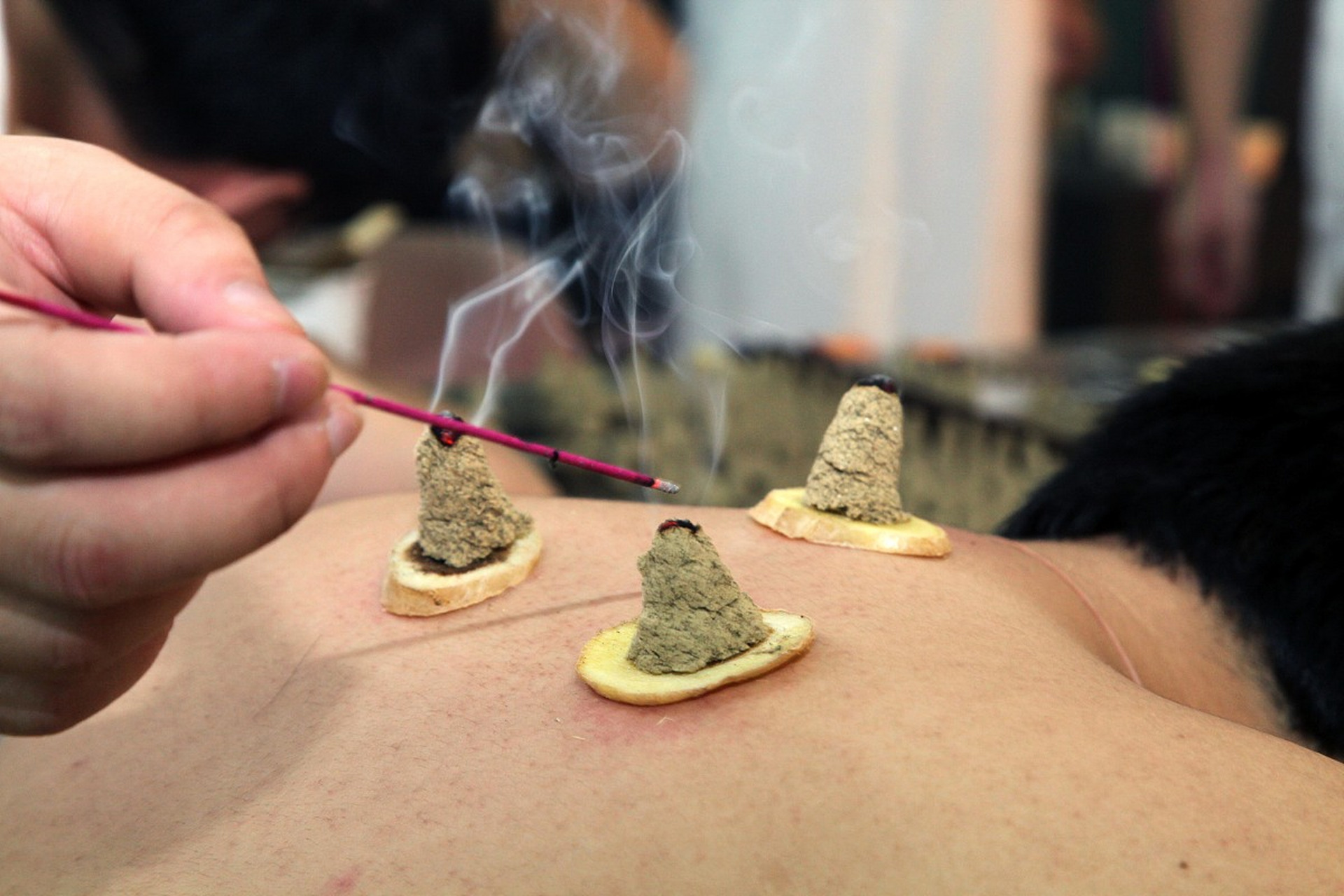 有许多的疾病,吃药可能不是最佳选择,中医可以通过针刺穴位或者艾灸