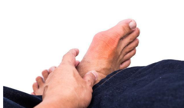 身体内尿酸高,哪个脚趾开始痛?这几点要知道