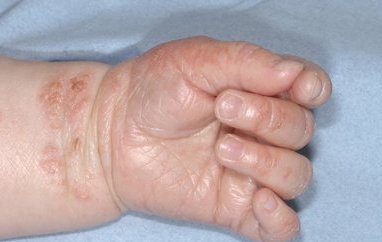 湿疹是属于一种过敏性皮炎,宝宝出现湿疹以后应该怎么办?