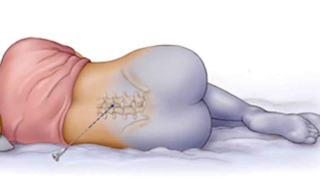 还没生娃的恭喜了!国家卫健委宣布:无痛分娩将全国推广