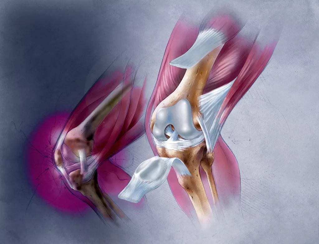 为什么膝盖发出声响?有这5种原因,3种是损伤征兆