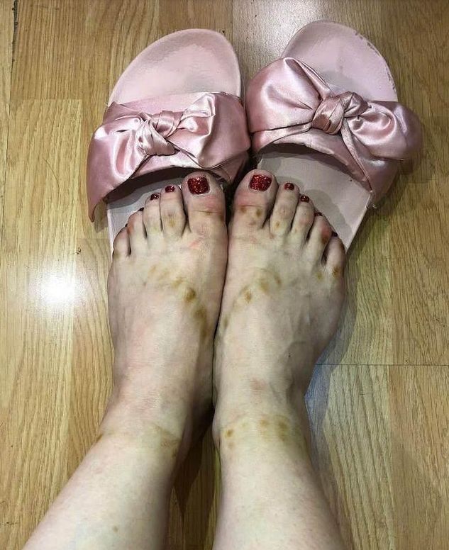 杨紫当跳了个舞,而她的脚严重变形