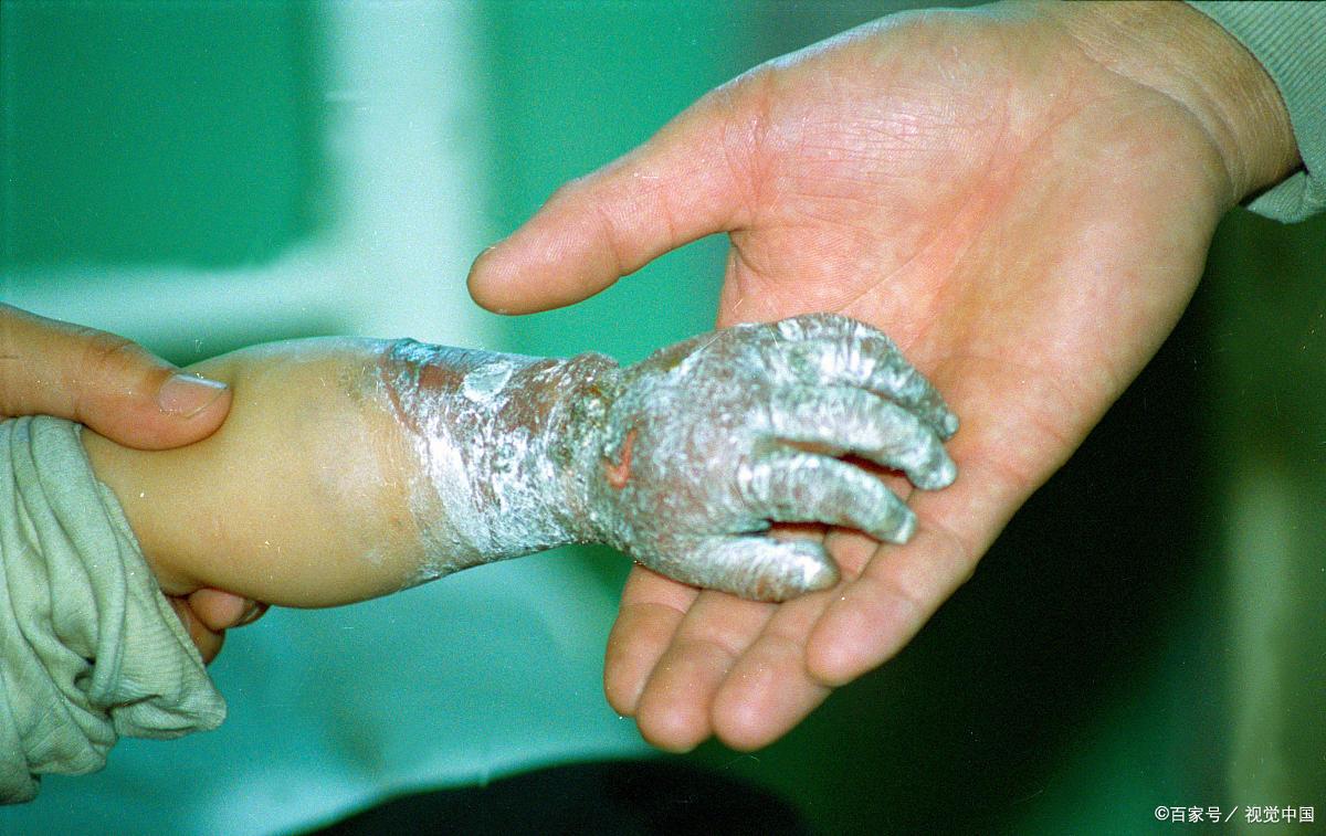 烧伤后创面苍白严重吗